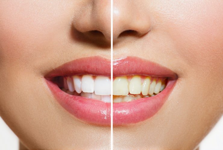 résultats du kit de blanchiment des dents